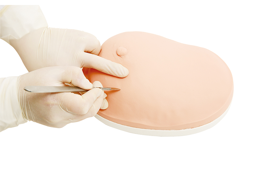 乳房良性腫物切除模型